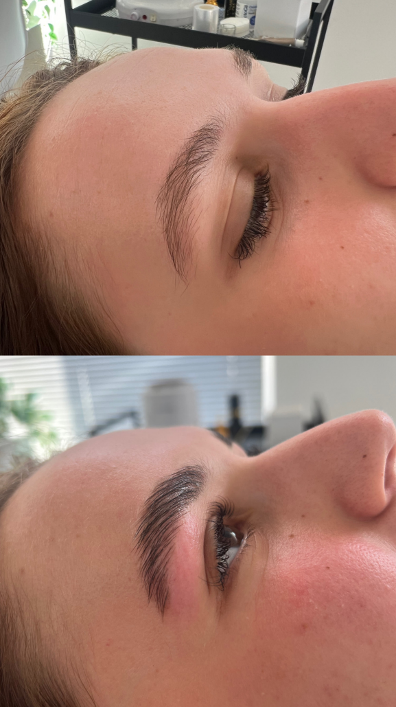 Example de Browlift